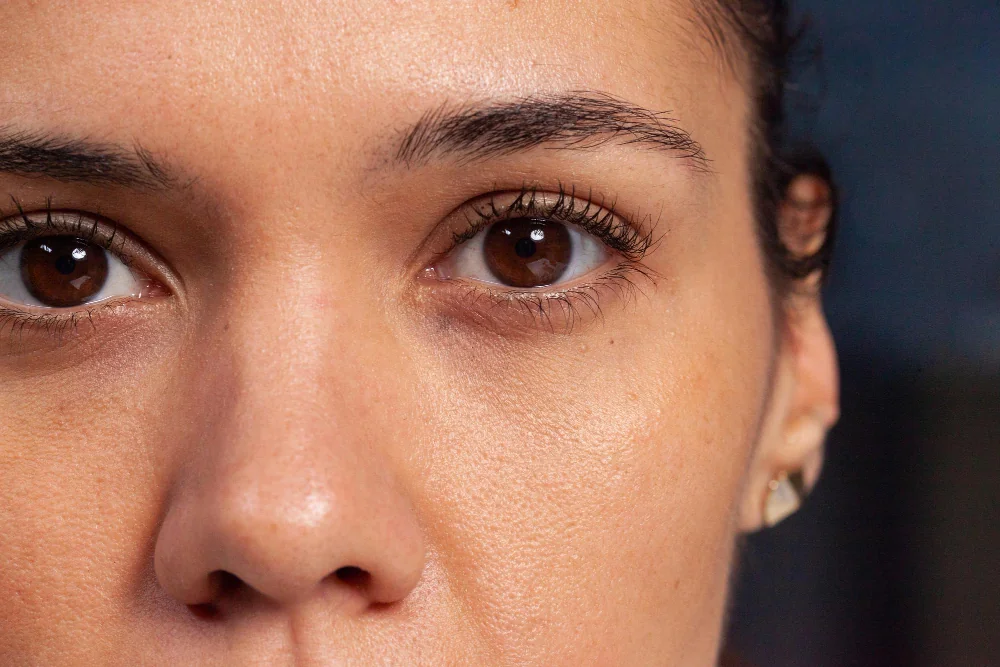 como quitar las ojeras pigmentadas mycliniq