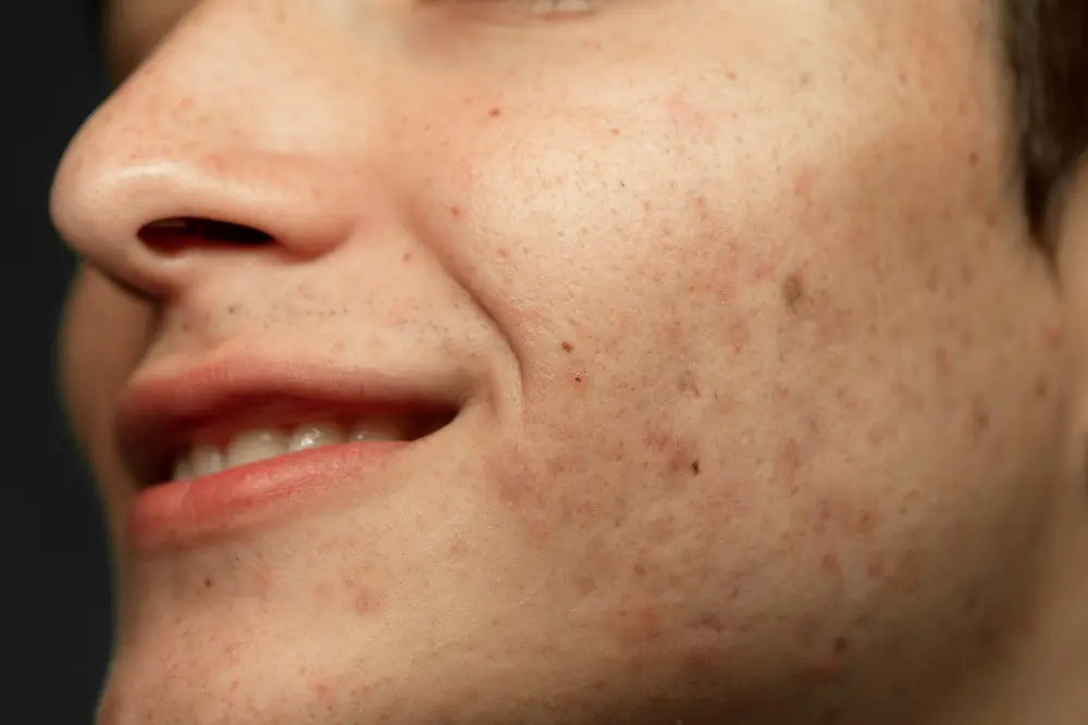 como quitar las manchas cara