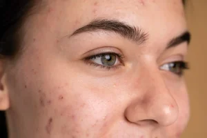 como quitar las manchas de la cara